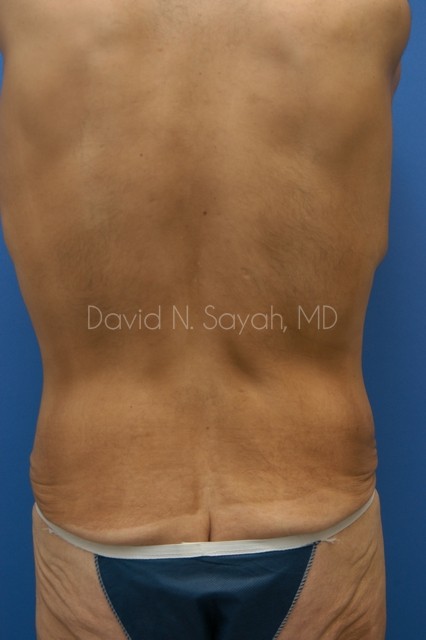 Back Tuck Belt Lipectomy Before and After | simply males