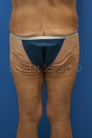 Buttock Lift Before and After | simply males