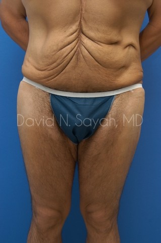 Buttock Lift Before and After | simply males