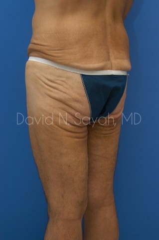 Buttock Lift Before and After | simply males