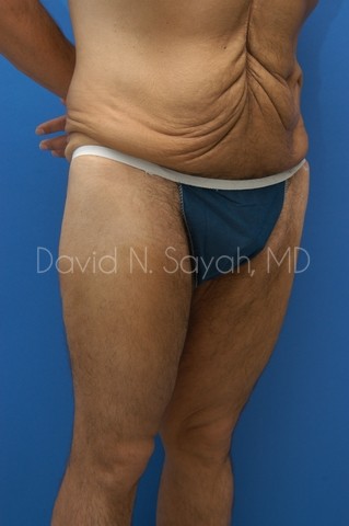 Buttock Lift Before and After | simply males