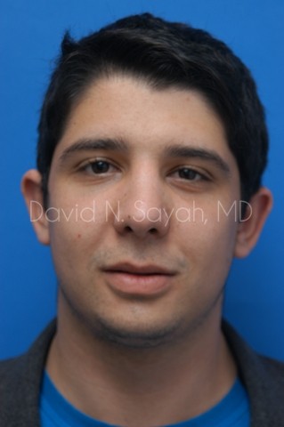 Chin Implant Before and After | simply males