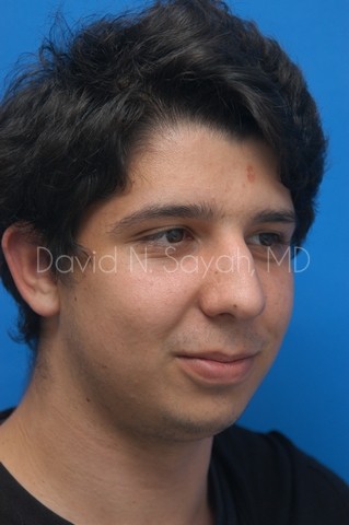 Chin Implant Before and After | simply males