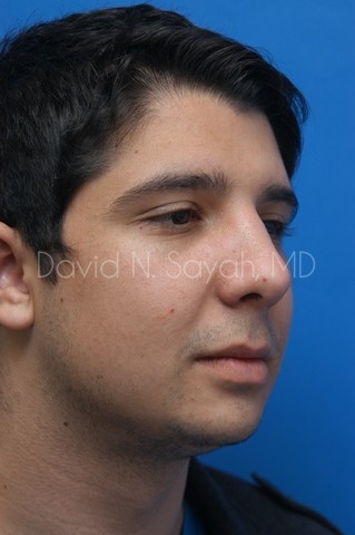 Chin Implant Before and After | simply males