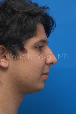 Chin Implant Before and After | simply males