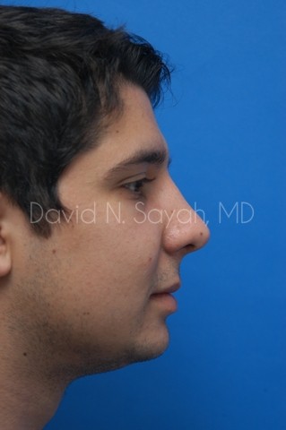 Chin Implant Before and After | simply males