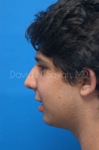 Chin Implant Before and After | simply males