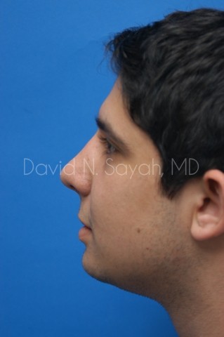 Chin Implant Before and After | simply males