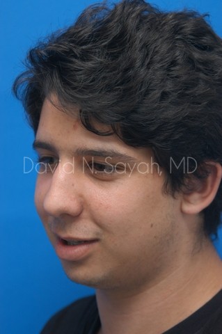 Chin Implant Before and After | simply males