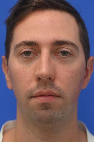 Chin Implant Before and After | simply males