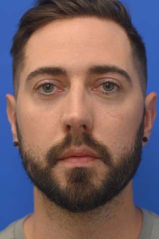 Chin Implant Before and After | simply males