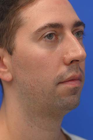Chin Implant Before and After | simply males