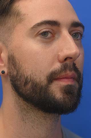 Chin Implant Before and After | simply males