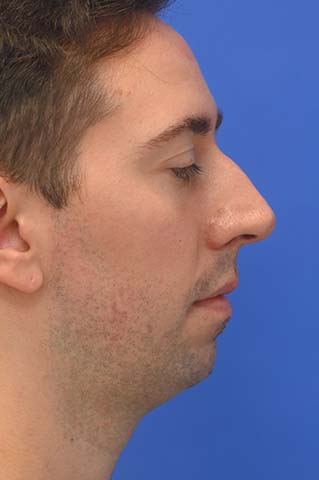 Chin Implant Before and After | simply males