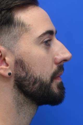 Chin Implant Before and After | simply males