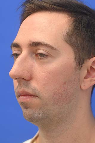 Chin Implant Before and After | simply males