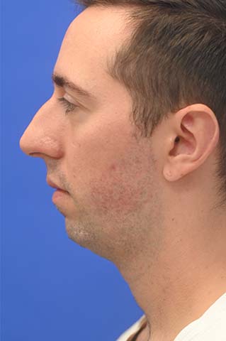 Chin Implant Before and After | simply males