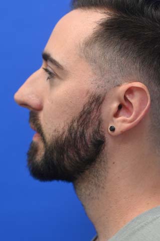 Chin Implant Before and After | simply males