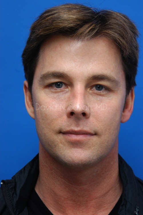 Co2 Laser Before and After | simply males