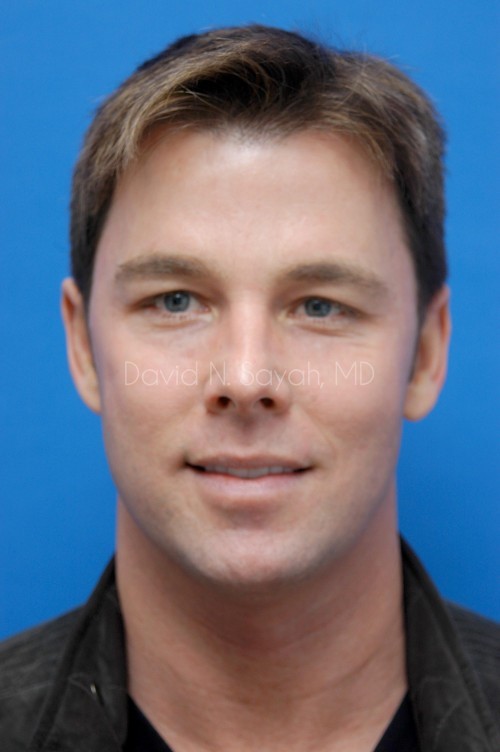 Co2 Laser Before and After | simply males