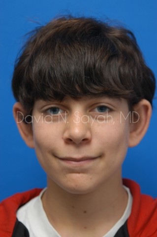 Ear Surgery Before and After | simply males