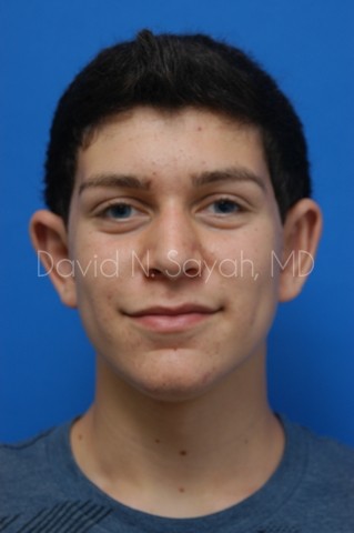 Ear Surgery Before and After | simply males