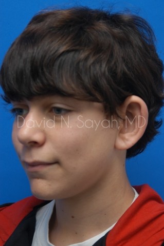 Ear Surgery Before and After | simply males