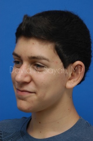 Ear Surgery Before and After | simply males