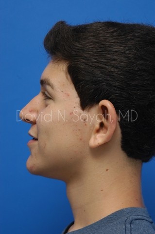 Ear Surgery Before and After | simply males