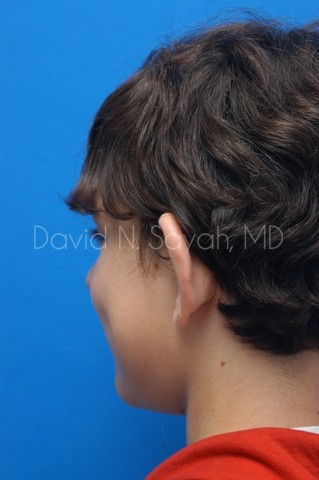 Ear Surgery Before and After | simply males