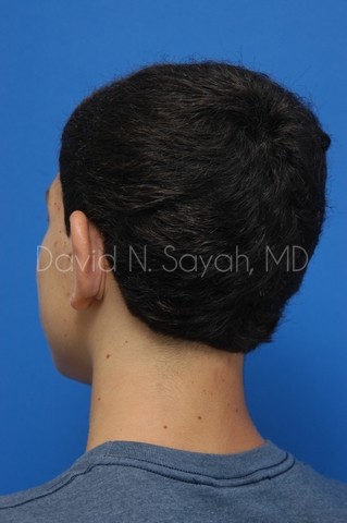 Ear Surgery Before and After | simply males