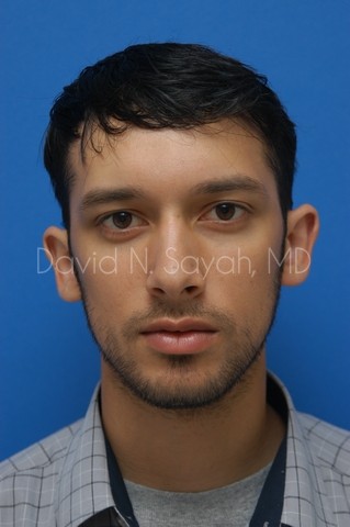 Ear Surgery Before and After | simply males