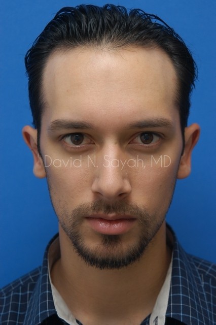 Ear Surgery Before and After | simply males