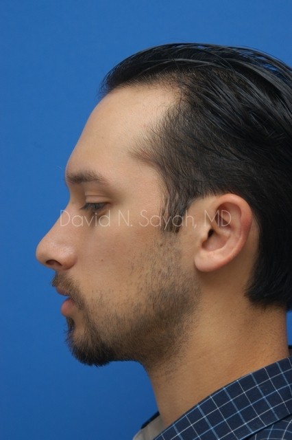 Ear Surgery Before and After | simply males