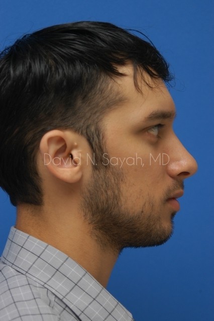 Ear Surgery Before and After | simply males