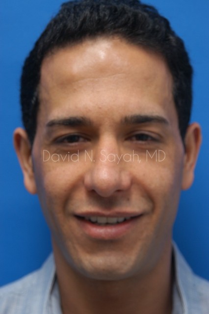 Eyelid Surgery Before and After | simply males