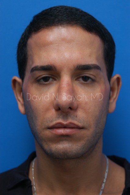 Eyelid Surgery Before and After | simply males