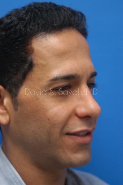 Eyelid Surgery Before and After | simply males