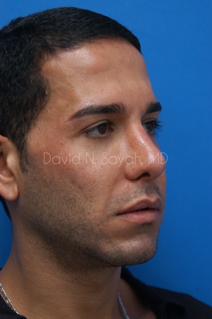 Eyelid Surgery Before and After | simply males