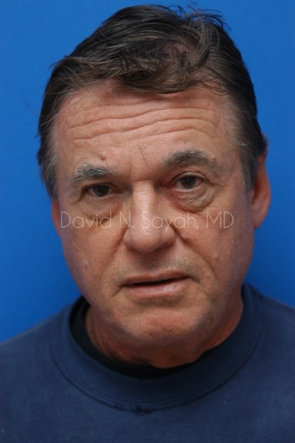 Eyelid Surgery Before and After | simply males