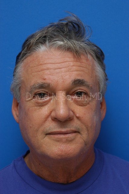 Eyelid Surgery Before and After | simply males