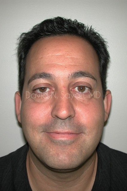 Eyelid Surgery Before and After | simply males