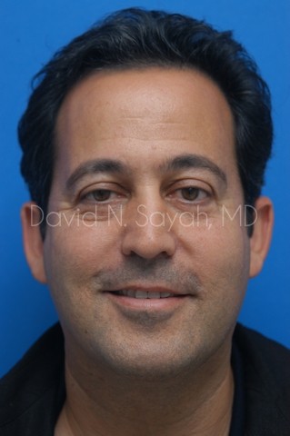 Eyelid Surgery Before and After | simply males