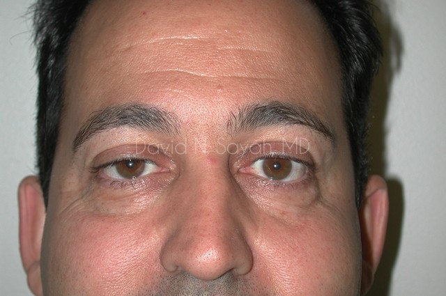 Eyelid Surgery Before and After | simply males