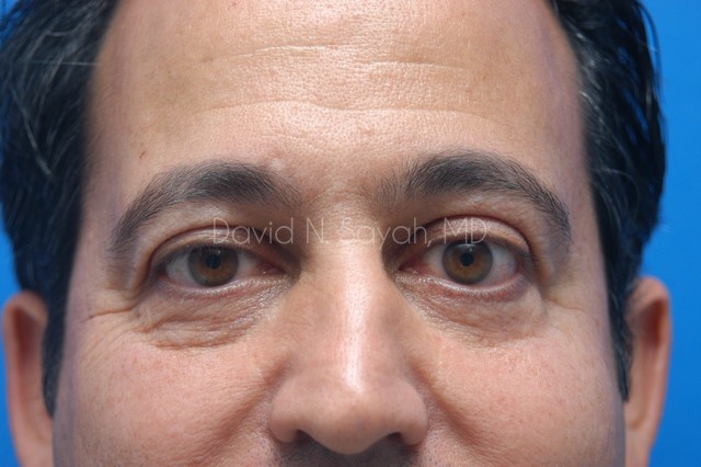 Eyelid Surgery Before and After | simply males
