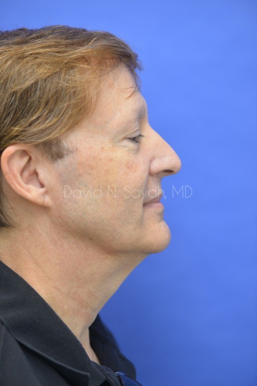 Facelift Before and After | simply males
