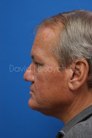 Facelift Before and After | simply males