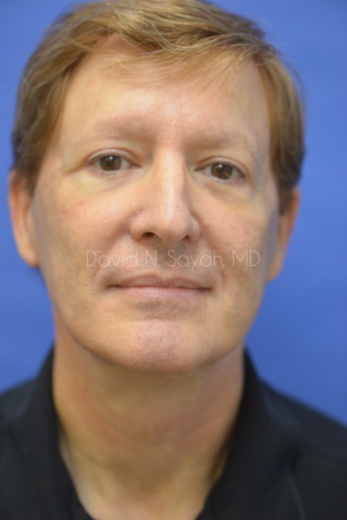 Fat Injection (face) Before and After | simply males