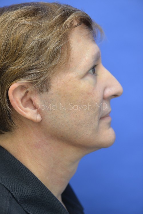 Fat Injection (face) Before and After | simply males