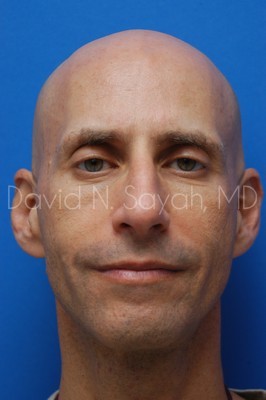 Fat Injection (face) Before and After | simply males